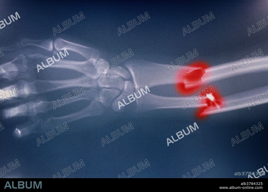 Broken arm. Colored X-ray of a compound fracture of the radius and ulna in the forearm of a 21 year old man. The radius is the upper of the two arm bones with the bones of the hand at left. Both the radius and ulna are fractured, and the fracture has left each bone with sharp broken ends (highlighted in red) which may pierce the skin. This is known as a compound fracture. The larger radius is aligned with the thumb of the hand. Most fractures are caused by sudden injury that exerts more force on the bone than it can withstand. X-rays can confirm the diagnosis. This fracture may be repaired by surgery to realign and immobilise the bones.