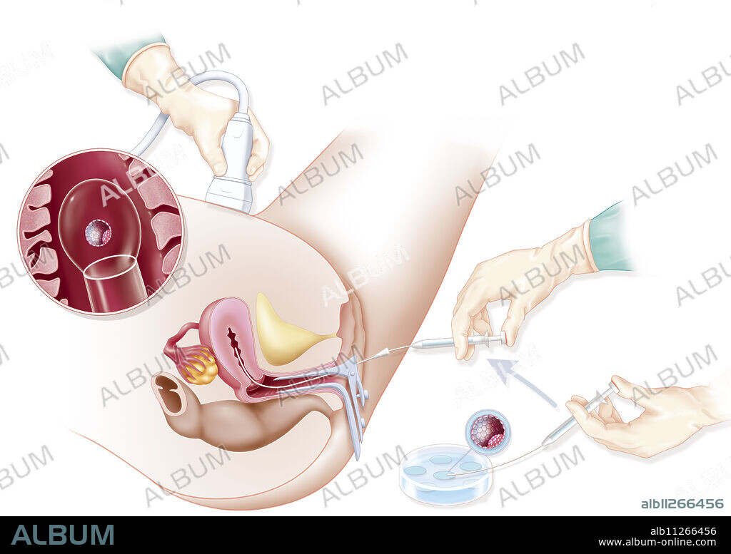 Illustration of the transfer of embryos, obtained through IVF, guided by ultrasound. The transferred embryos will implant themselves in the days following their transfer into the uterus. This is the last medical act involved in the IVF procedure.