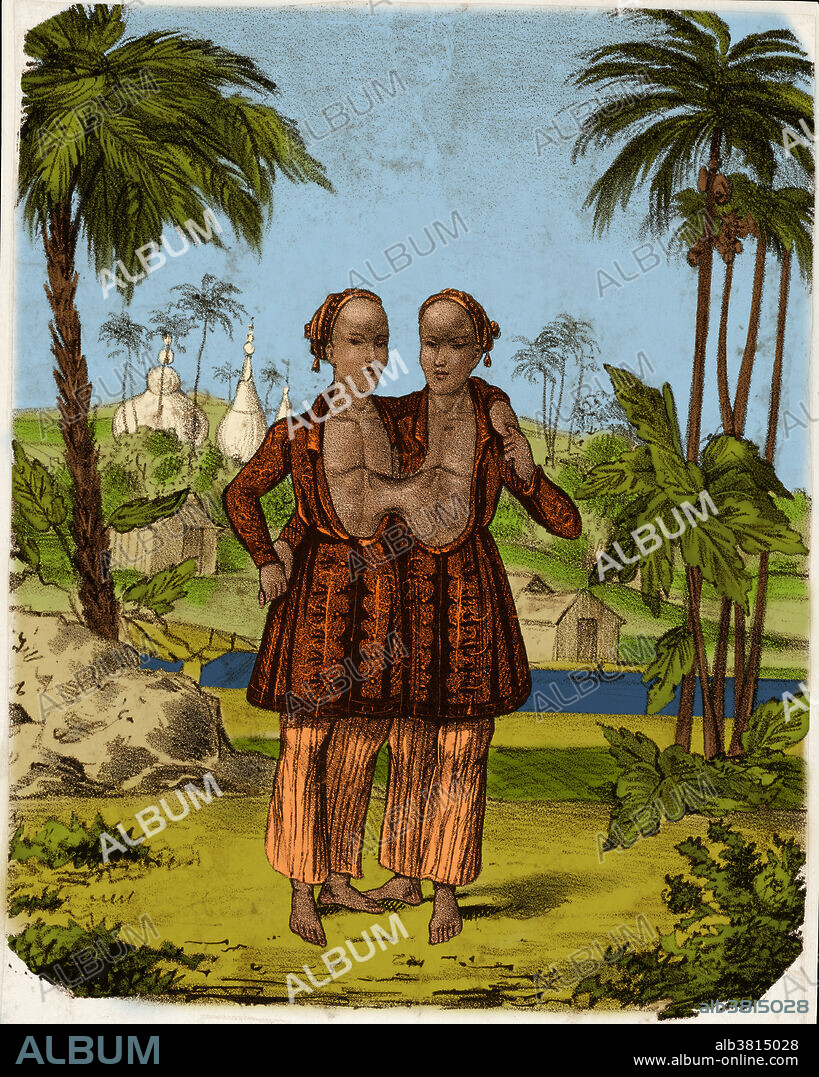 Chang and Eng (1811-1874) were conjoined twin brothers born in Siam (now Thailand), giving rise to the term Siamese twins. They were joined at the sternum (breast bone), and their livers were fused but functioned independently. After being discovered by a British merchant in 1829, they were exhibited around the world as a curiosity. They later settled in North Carolina, USA, and became naturalized US citizens. They bought a plantation and slaves, adopted the last name Bunker, and raised families. The twins died on the same day in January 1874. Chang, who had pneumonia, died in his sleep. Eng refused to be separated from his dead brother, and died a few hours later.