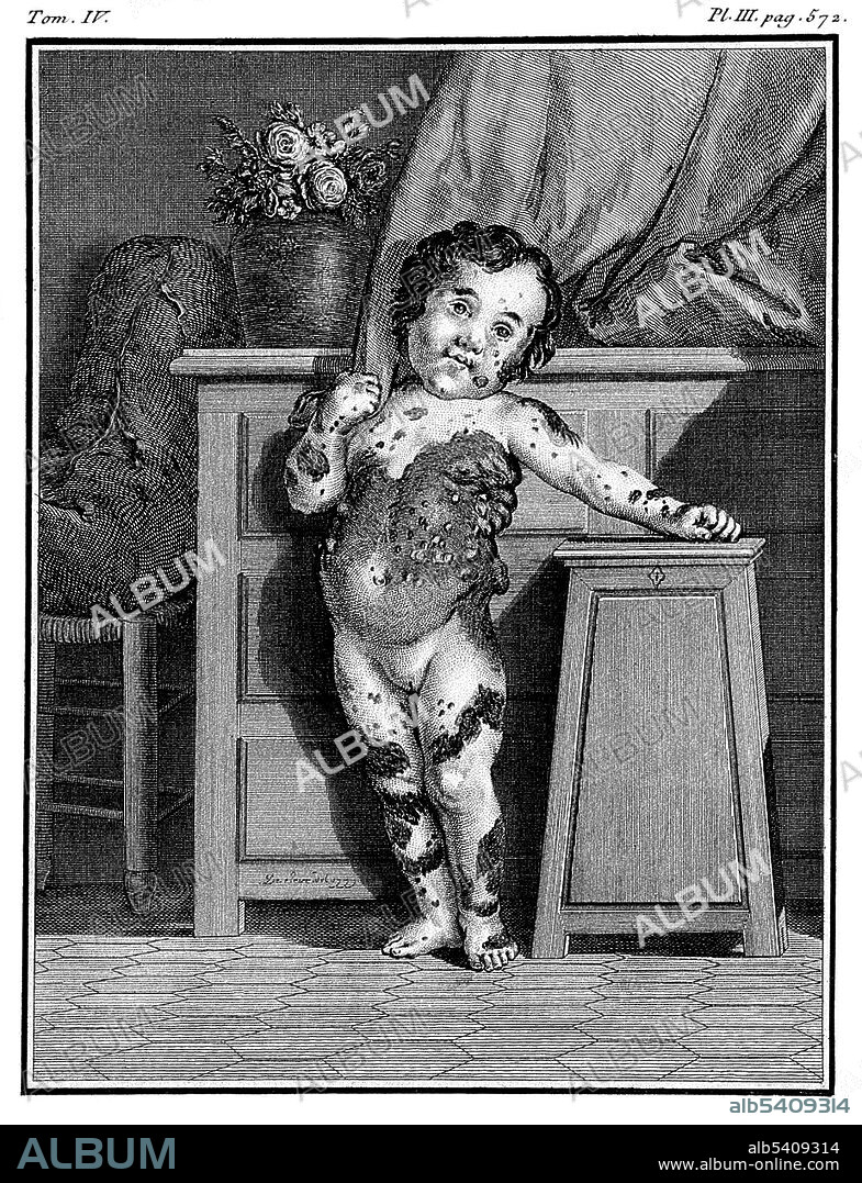 Comte de Buffon: Histoire Naturelle. Maria Herig, a girl with a skin disease identified as multiple fibroma. The Histoire Naturelle, générale et particulière, avec la description du Cabinet du Roi (Natural History, General and Particular, with a Description of the King's Cabinet) is an encyclopedic collection of 36 large (quarto) volumes written between 1749-1804 by the Comte de Buffon, and continued in eight more volumes after his death by his colleagues. The books cover what was known of the natural sciences at the time, including what would now be called material science, physics, chemistry and technology as well as the natural history of animals. It is accompanied by some discourses and a theory of the earth by way of introduction, and by supplements including an elegantly written account of the epochs of nature. Georges Louis Leclerc, Comte de Buffon (September 7, 1707 - April 16, 1788) was a French naturalist, mathematician, cosmologist, and encyclopedic author. He epitomizes the revolutionary changes that the Enlightenment brought to the study of nature. More than anyone else, he was responsible for the acceptance of a long-time scale for the history of the earth. He died in 1788 at the age of 80. Line engraving by C. Baron after Jacquesde Sève.