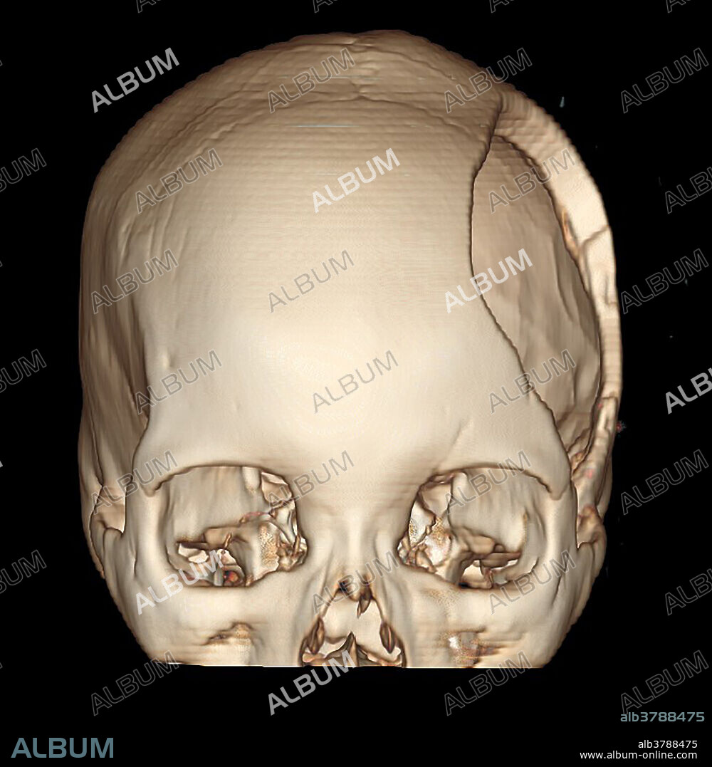 This frontal view from a 3D CT reconstruction derived from a CT of the head shows the appearance of a hemicraniectomy which is removal of a significant portion of the skull. This is often done when there is significant elevation of intracranial pressure/brain swelling to allow the brain to expand without the limitation of the overlying skull which when intact only provides a restricted intracranial volume.