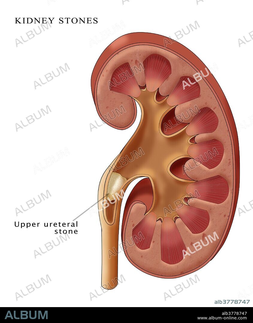 Illustration of an upper ureteral kidney stone. Kidney stones are formed when mineral salts, most often involving calcium, accumulate on the inner surfaces of the kidney. As they grow they may block the flow of urine out of the kidney, causing extreme pain.