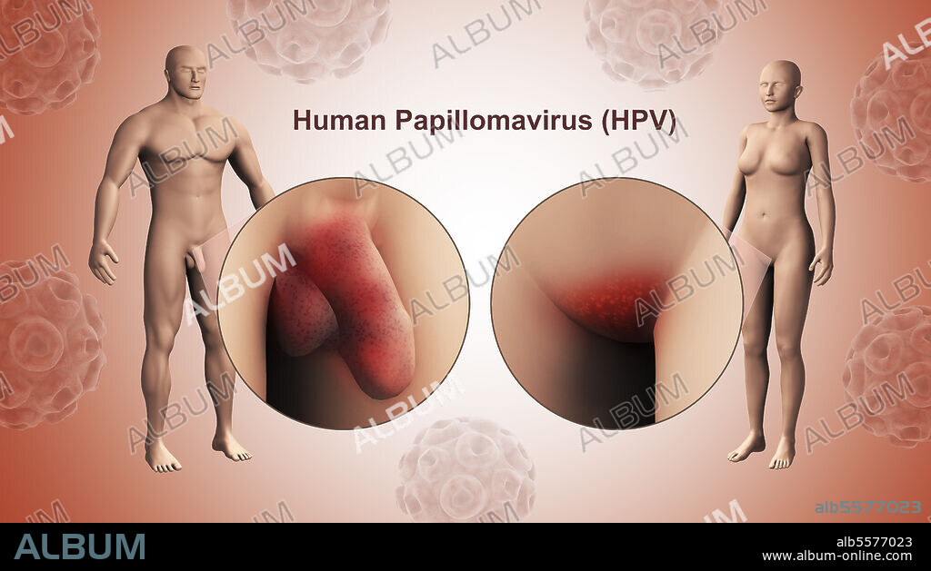 Medical illustration of the human papillomavirus infection (HPV infection) in the male and female genitals.