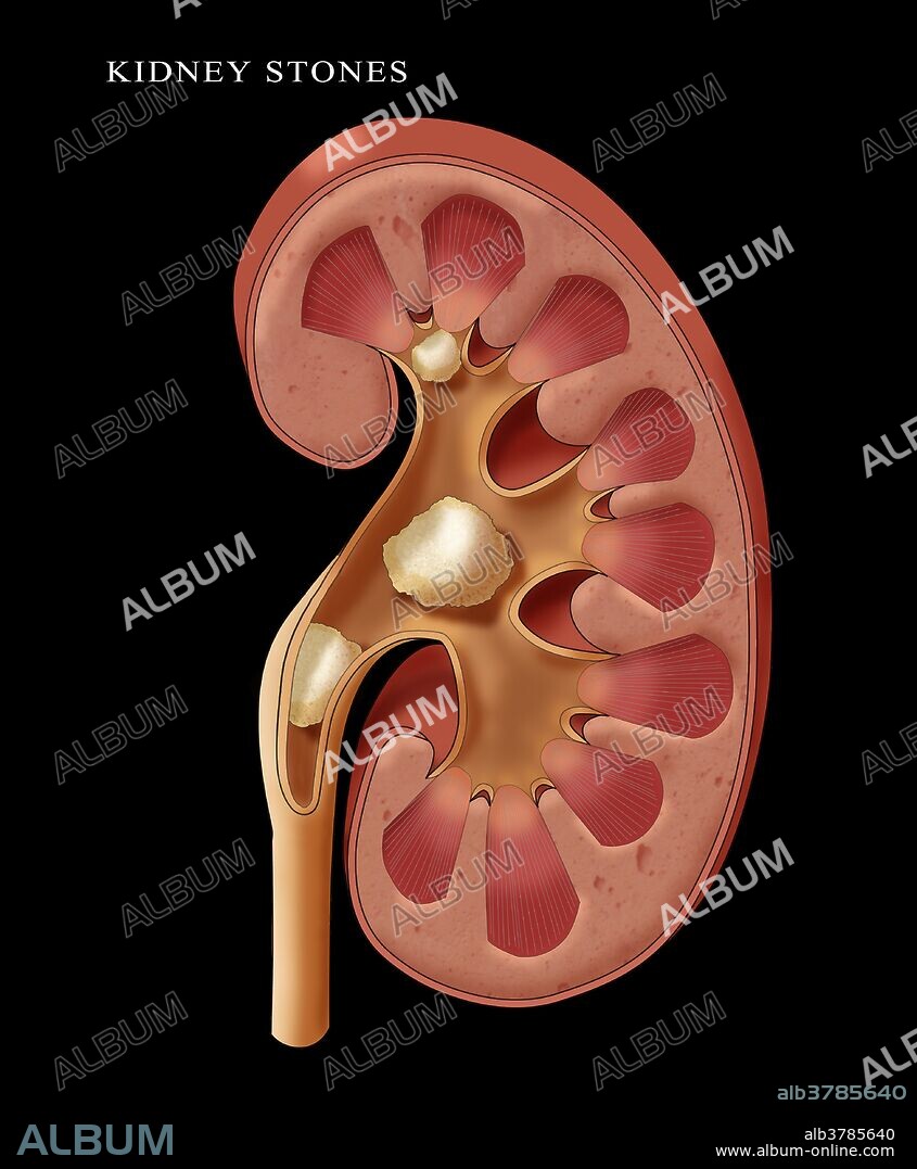 Renal Pelvic Stone, Illustration
