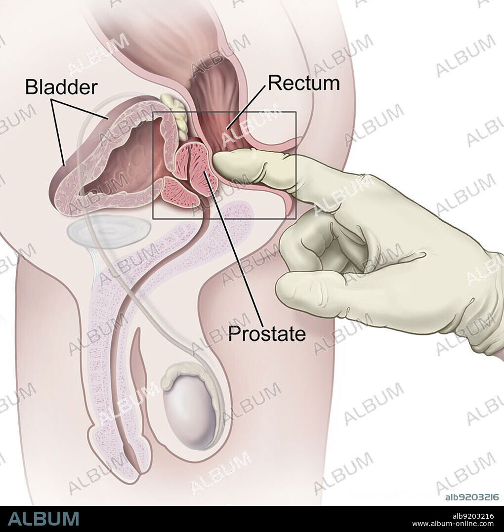 A doctor performs a digital rectal exam (DRE) by inserting a lubricated, gloved finger into the rectum to feel for abnormalities. The bladder, rectum, and prostate are labeled. A rectal examination, commonly called prostate exam, is an internal examination of the rectum performed by a physician or other healthcare professional.