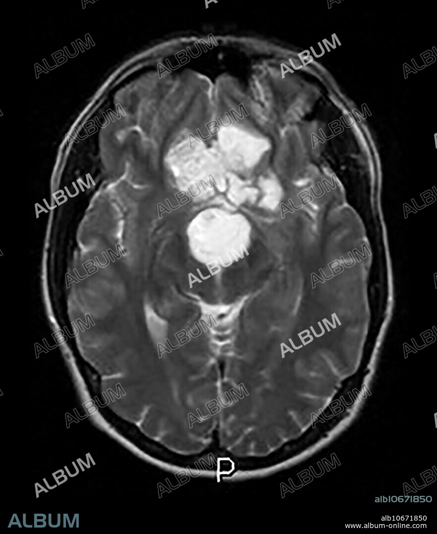 This axial (cross sectional) T2 weighted MR image shows a mass lesion with heterogeneous signal in the inferior frontal region which represents a benign, congenital Dermoid Cyst.