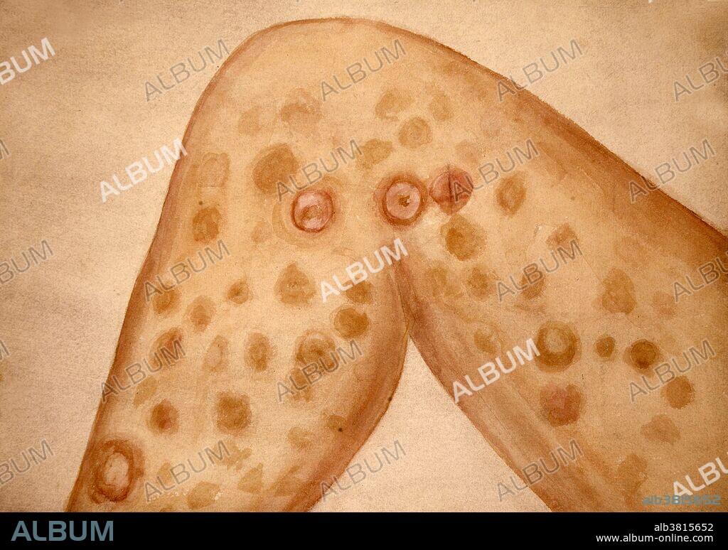 Watercolor drawing illustrating the condition of the skin in a patient who suffered from mycosis fungoides, also known as granuloma fungoides or Alibert-Bazin syndrome. It is the most common form of cutaneous T-cell lymphoma. It generally affects the skin, but may progress internally over time. The drawing shows the marks left on the skin of the inner thigh and knee by a universal eruption three years after the primary granulomatous tumor on the chest. There are pronounced marks due to sloughing of the skin. Leonard Mark, 1893.