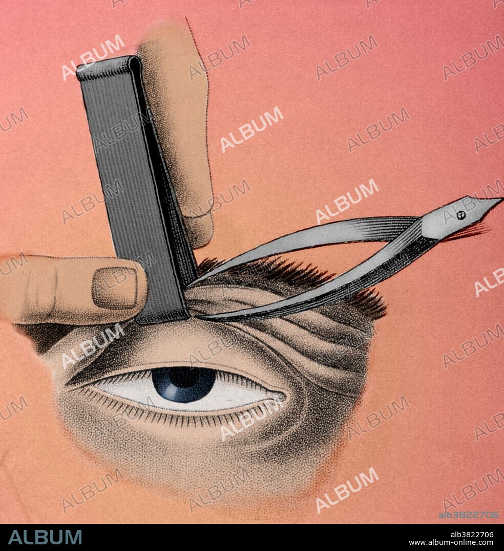 Illustration showing the surgical procedure to correct a lazy upper eyelid (ptosis), circa 1830.