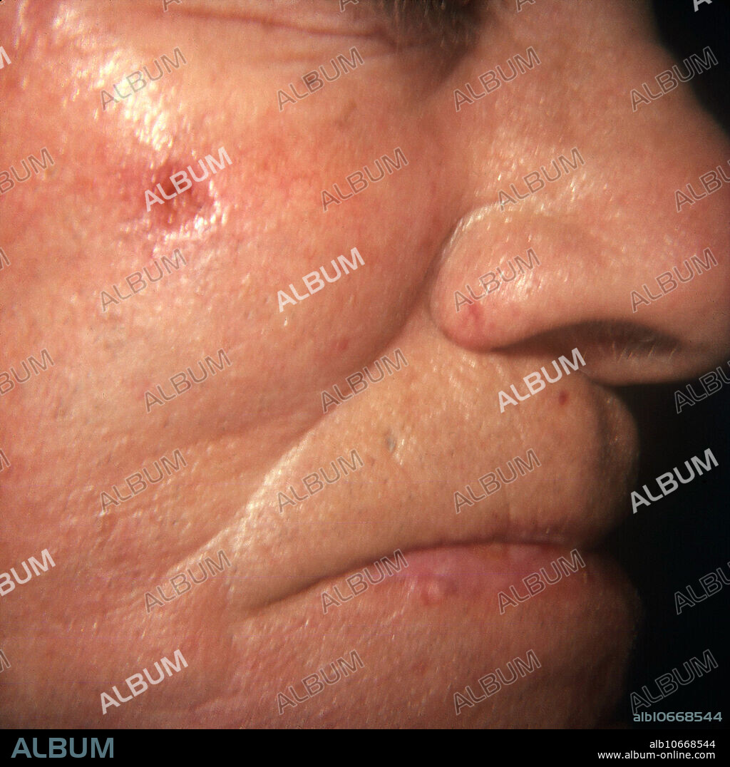 Rodent ulcer, a basal cell carcinoma, mimicking an infection or ulcer. Rodent ulcers are the most common form of skin cancer among fair-skinned people, mostly affecting the elderly. The tumour normally appears on the face, and starts as a small, flat nodule that grows slowly into the surrounding tissue, breaking down at the centre to form a shallow ulcer. Fortunately, rodent ulcers seldom spread cancer to other parts of the body. Treatment includes surgical removal, cryosurgery (freezing) and radiotherapy.