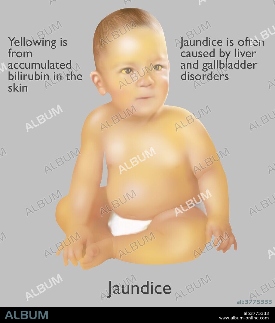 Illustration of an infant with jaundice. Jaundice is often caused by liver and gallbladder disorders. The yellow color comes from accumulated bilirubin in the skin.