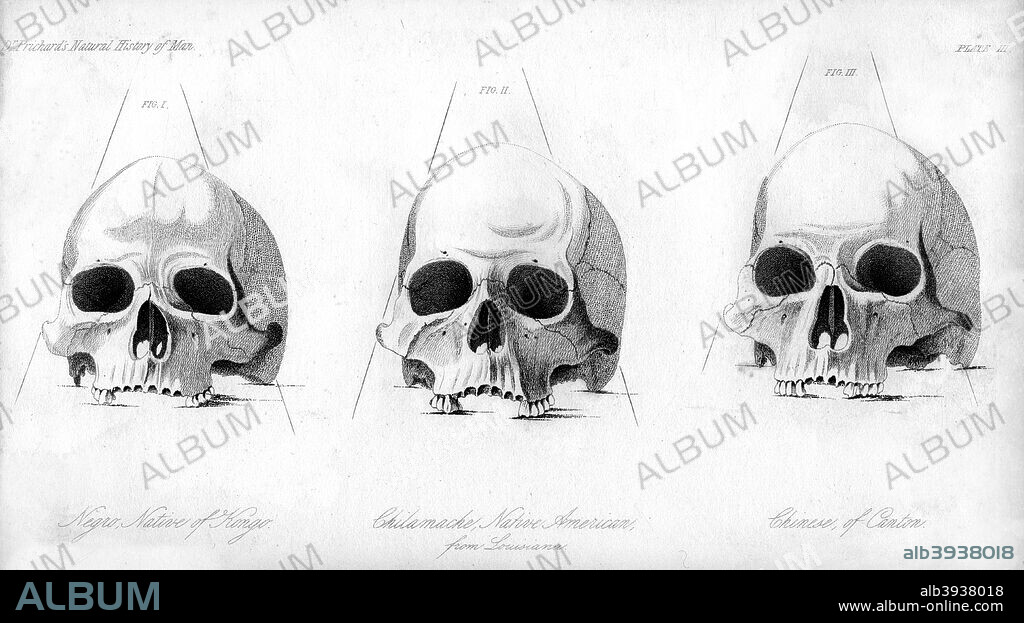 Three types of human skull, 1848. Comparison of a Negro (native of Kongo), Chilamache native American (from Louisiana), and Chinese (from Canton). During the 19th century, it was believed that negroes and other races were less developed than Europeans. An engraving from the Natural History of Man, by James Cowles Prichard, (Hippolyte Bailliere, London, third edition, 1848).