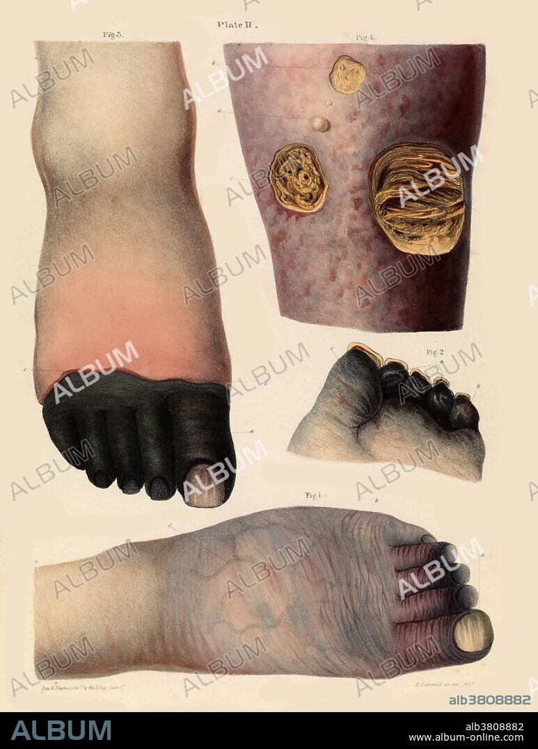 Gangrene illustration from the 1830s. Figs 1 and 2 (bottom and centre right) show gangrena senilis - discoloration of the toes at the beginning of the disease. Fig 3 (top left) shows gangrene of the toes. Fig 4 (top right) shows mortification of the skin and subjacent cellular tissue from an obstacle to the return of the venous blood in consequence of disease of the heart. Robert Carswell.