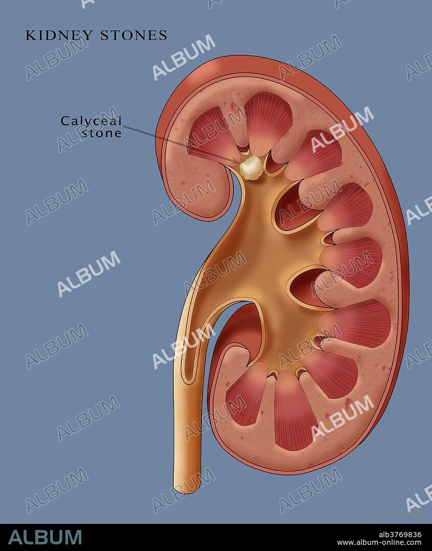 Illustration of a kidney stone present in one of the calyxes; a calyceal stone. Kidney stones are formed when mineral salts, most often involving calcium, accumulate on the inner surfaces of the kidney. As they grow they may block the flow of urine out of the kidney, causing extreme pain.