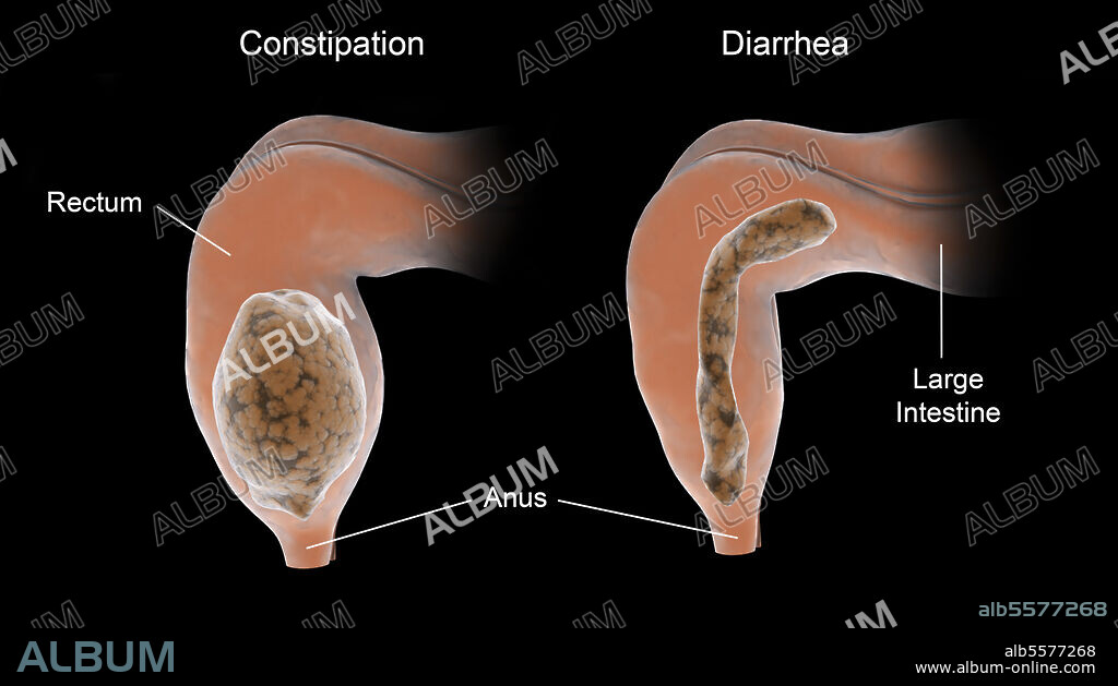 Comparison diagram of constipation vs. diarrhea in the human body.