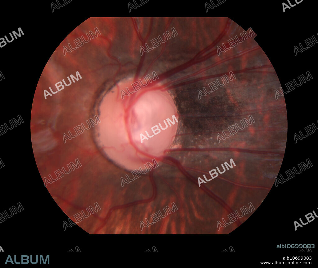 Optic disc affected by macular dragging.
