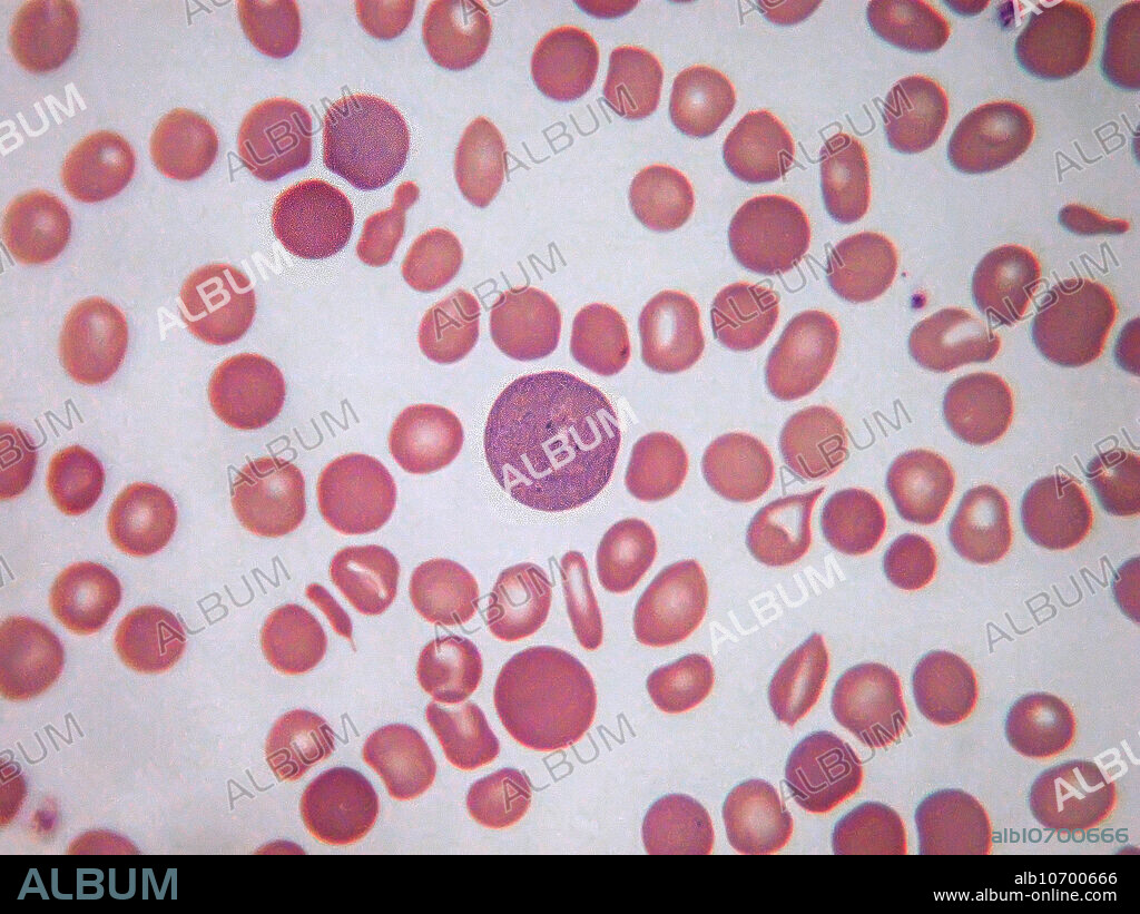 Polychromasia (also known as Polychromatophilia) is a disorder where there is an abnormally high number of immature red blood cells found in the bloodstream as a result of being prematurely released from the bone marrow during blood formation. These cells are often shades of greyish blue. Giemsa stain is used to distinguish young and old red blood cells. Light micrograph, Wright-Giemsa stain. Magnification: 100x.
