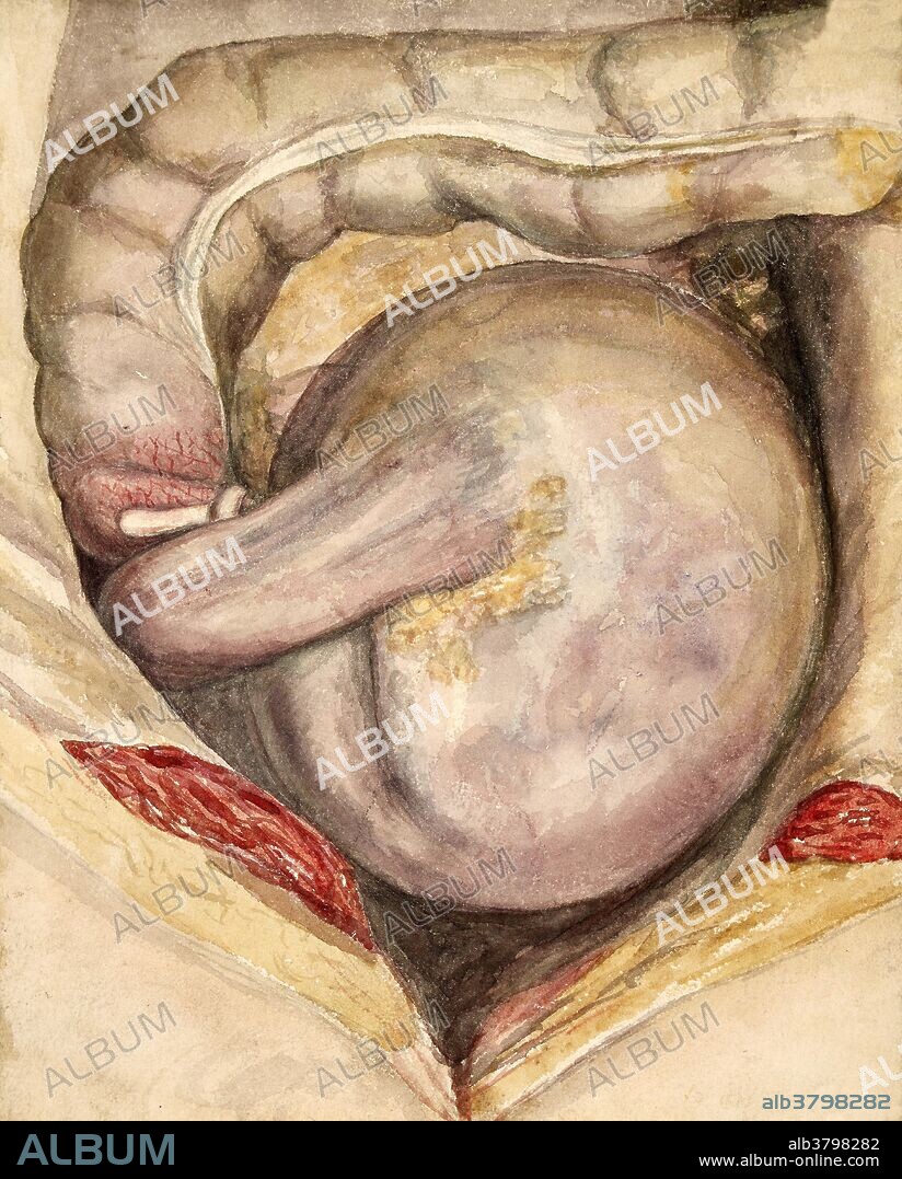 Watercolor drawing and ink diagram of a case of volvulus of the ascending colon, occurring in a man aged 35 years. The cecum was enormously distended, and occupied the whole of the lower abdomen. The cecum is twisted through one complete revolution, so as to lead to its complete occlusion. There was a long vermiform appendix and a rather voluminous meso-ileum. A volvulus is a subtype of malrotation, in which a loop of bowel is twisted about a focal point along the mesentery attached to the intestinal tract, which may result in a bowel obstruction. Leonard Mark, 1887.