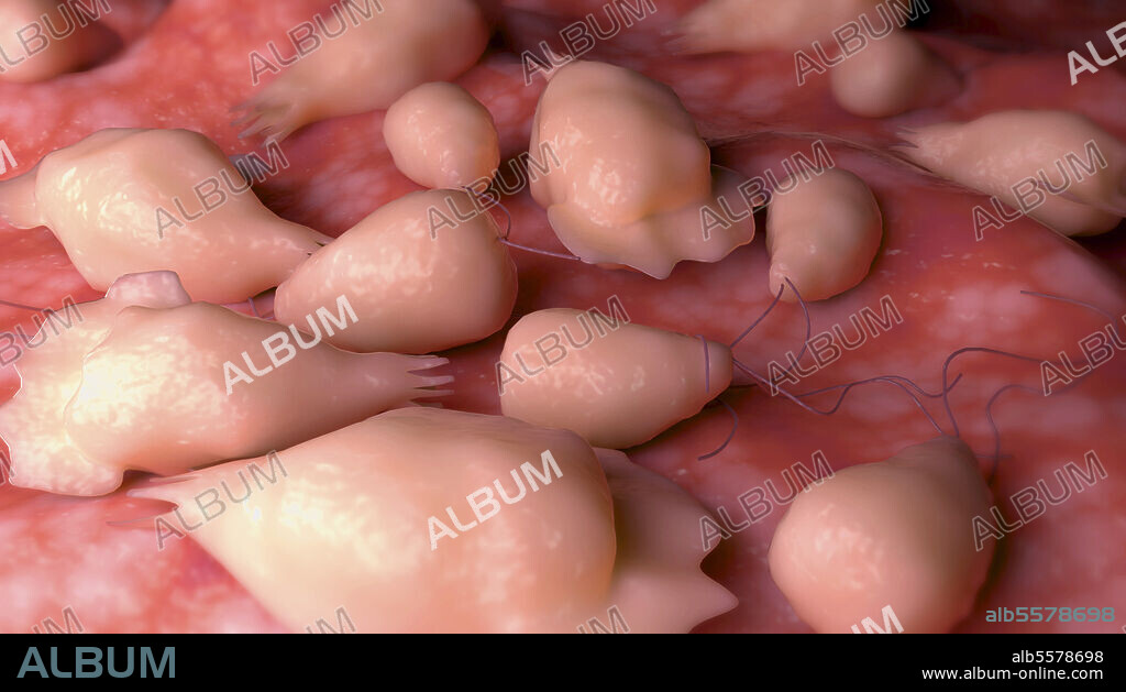 Conceptual biomedical illustration of primary amoebic meningoencephalitis, also known as Naegleriasis, on the surface of human brain.