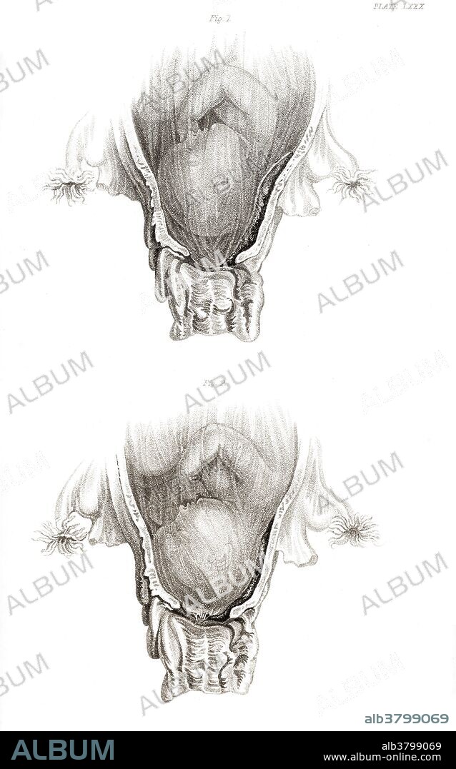 Placenta Previa, Illustration