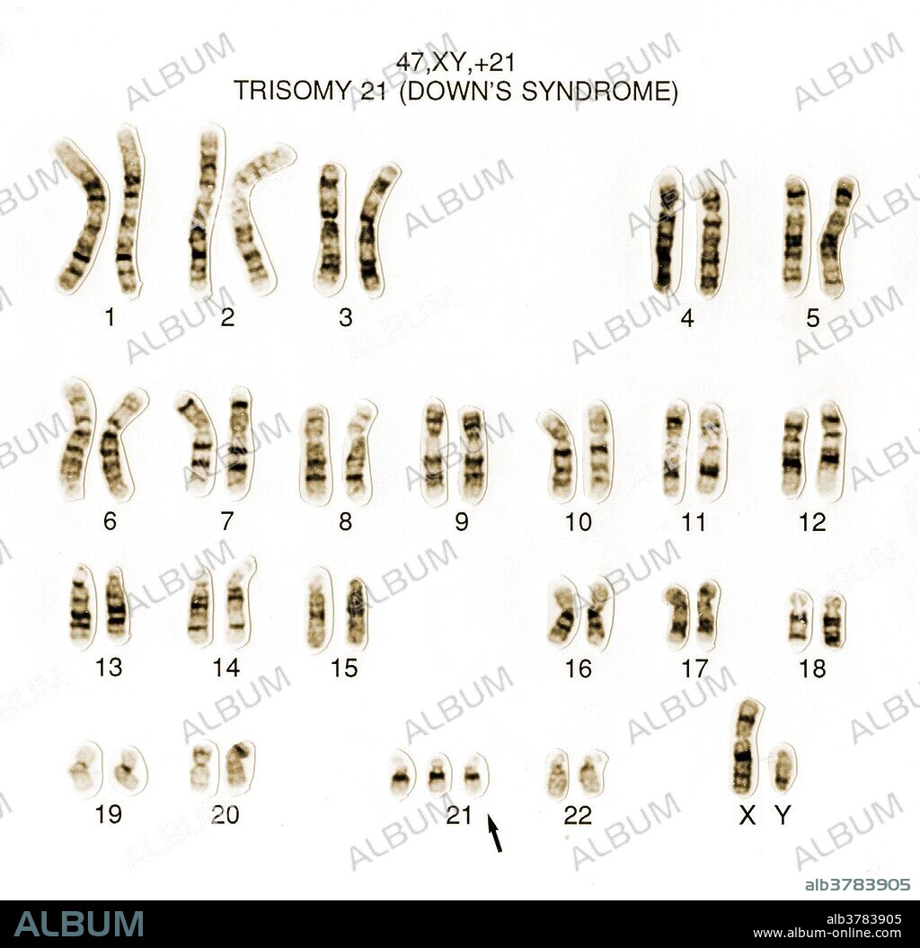 Down syndrome human karyotype 47, XY, +21. This male has a full chromosome complement plus an extra chromosome 21.