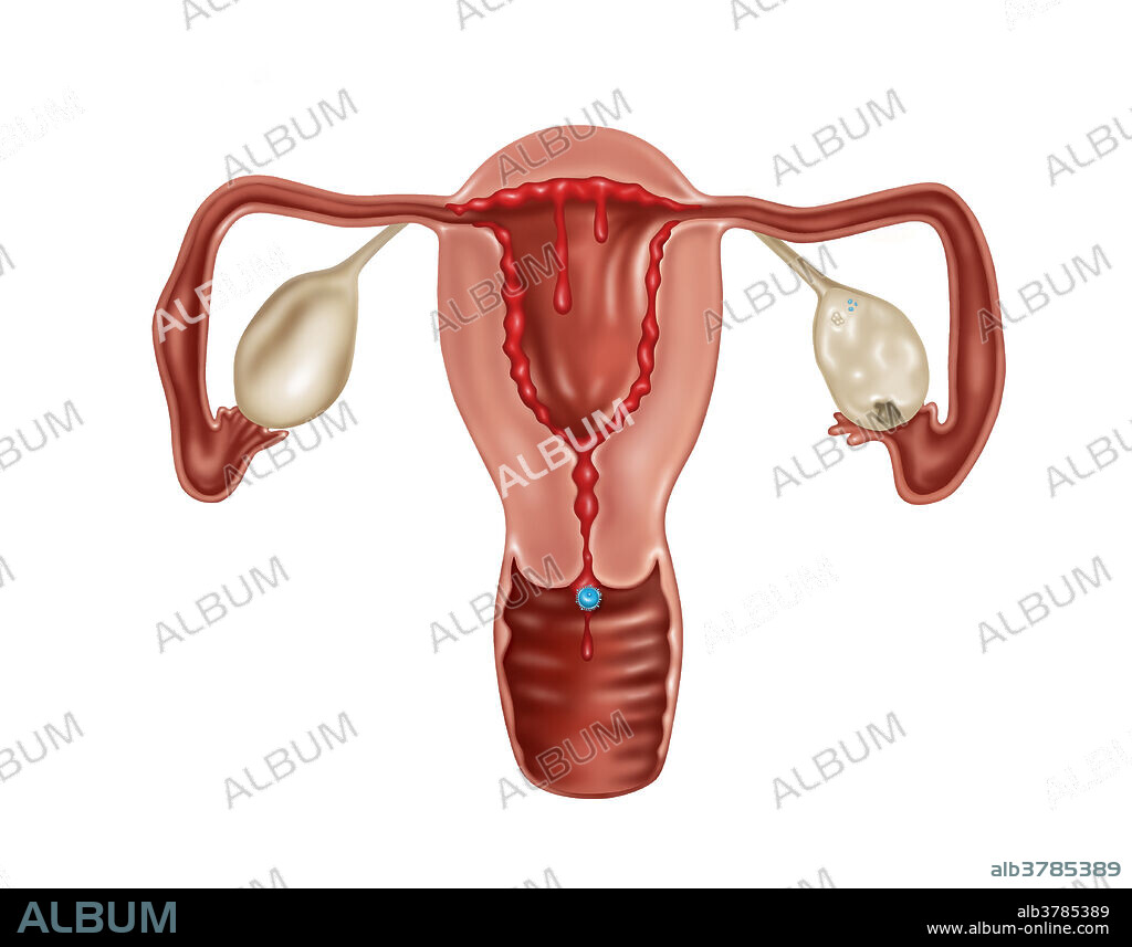 Illustration of a human uterus shedding the endometrium also known as the menstrual cycle.