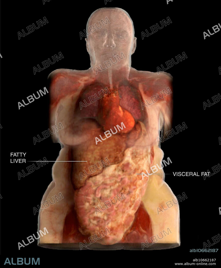 Medical visualization taken from human scanned data showing the anterior view of a liver affected by fatty liver disease as well as visceral fat around the intestines. Visceral fat, the kind deep inside the abdomen, releases inflammatory chemicals into the liver and creates long-term, system-wide inflammation. Chronic inflammation can cause a variety of illnesses, including asthma, autoimmune diseases, atherosclerosis, and cancer.