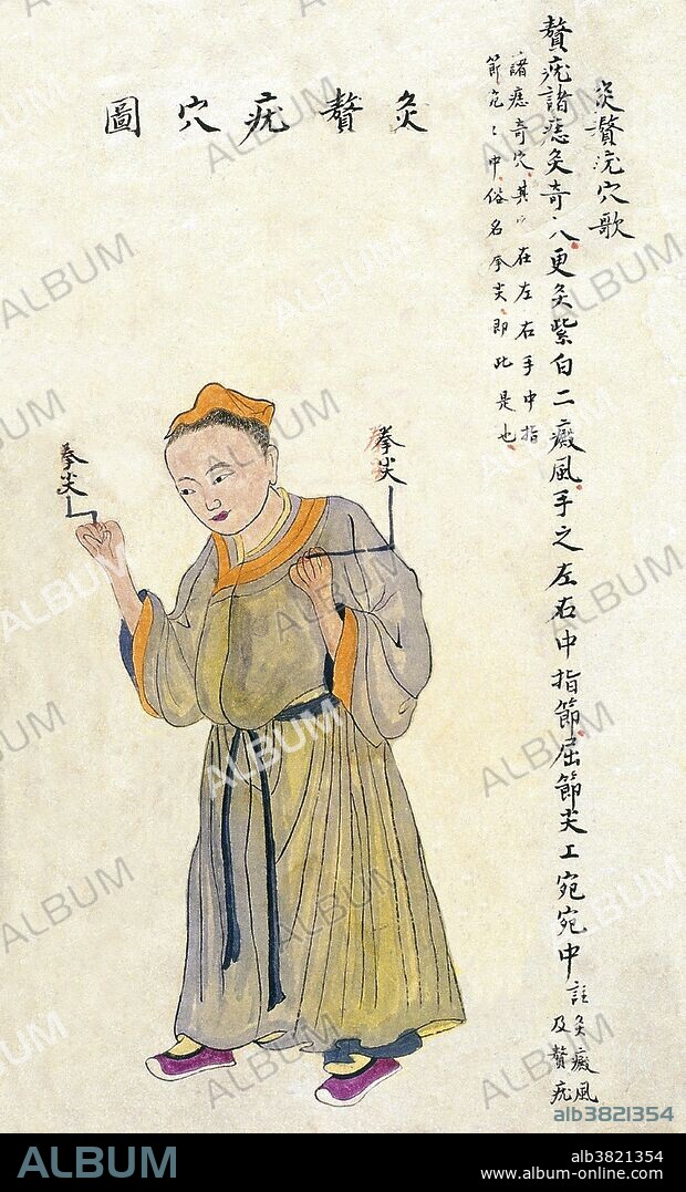 Acu-moxa point chart, showing the wart (zhuiyou) point, from Chuanwu lingji lu (Record of Sovereign Teachings), by Zhang Youheng, a treatise on acu-moxa in two volumes. This work survives only in a manuscript draft, completed in 1869 (8th year of the Tongzhi reign period of the Qing dynasty). To locate the wart point, one makes a fist. The point is at the end of the knuckle of the middle finger on both hands, and is thus popularly known as quanjian - end of the fist. Moxibustion at this point can cure warts; all kinds of moles; lichen planus (zidianfeng) and vitiligo (baidianfeng) etc.