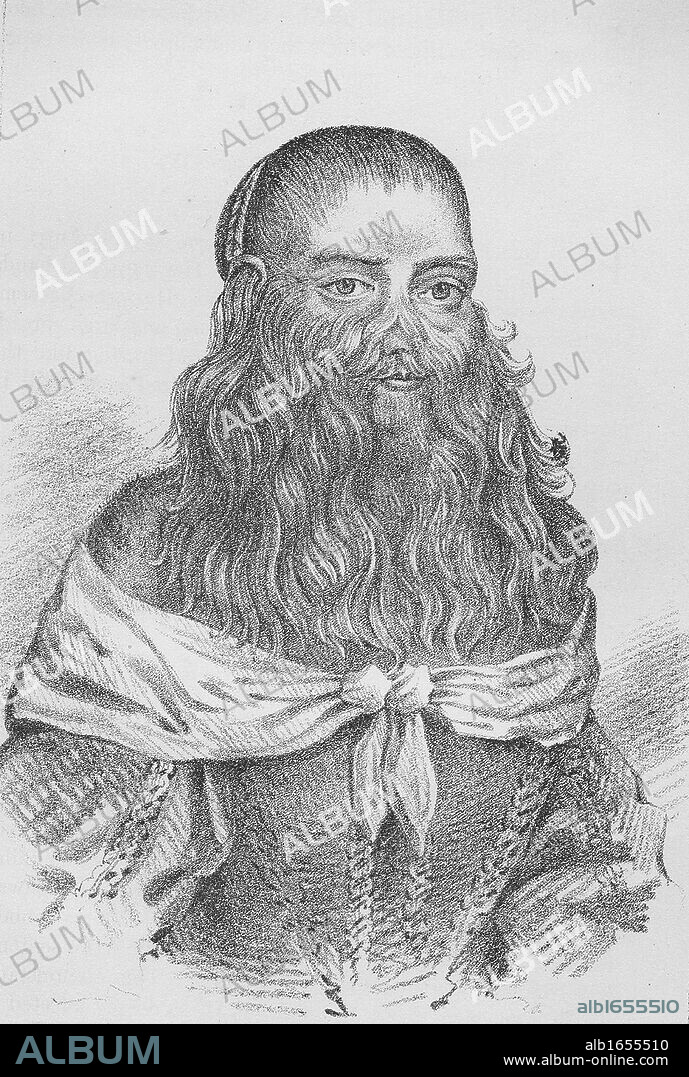 Barbara Urslerin, The Hairy Faced Woman, born in Germany in 1629 and exhibited as circus attraction. Suffered from Hypertrichosis (Ambras Syndrome). Lithograph published London 1815.