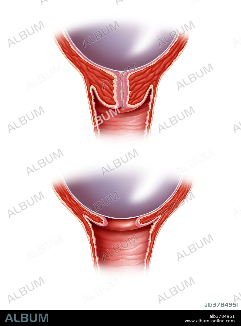 Unripe cervix (top) and a ripe cervix (bottom). A ripe cervix is softer and primed for childbirth.
