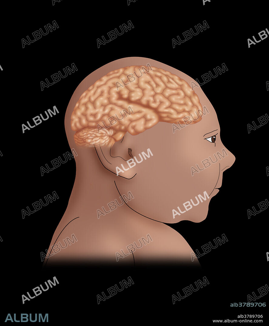 A conceptual illustration of microcephaly, a neurodevelopmental disorder associated with abnormal growth of the brain due to reduced head size. Microcephaly may be congenital or it may develop a few years after birth. Newborns affected by microcephaly may exhibit neurological defects, seizures, and impaired intellectual development. There's circumstantial evidence pointing to the Zika virus as a cause of a large number of cases of microcephaly in Brazil that is currently being investigated.