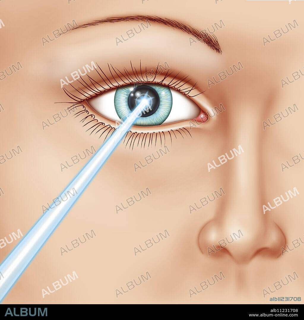 Illustration of laser eye surgery, used in various pathologies such a short-sightedness, presbyopia etc.