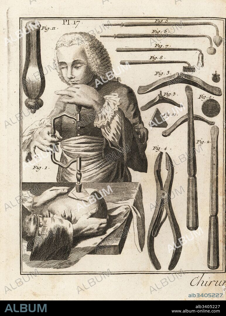18th century surgeon performing a trepanning operation on a man's head, with various surgical equipment: Jean Louis Petit's lever 2, trestle 3, Valet's pincers 4, cauterizers 5-8, round plaque 9, triangular plaque 10 and handle to mount cauterizer 11. Copperplate engraving by Robert Benard from Denis Diderot's Encyclopedia, Pellet, Geneva, 1779.
