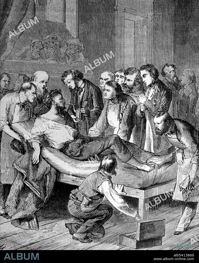 First use of surgical anesthesia. William Thomas Green Morton (1819-1868) was an American dentist. On September 30, 1846, Morton performed a painless tooth extraction after administering ether to a patient. Upon reading a newspaper account of this event, Boston surgeon Henry Jacob Bigelow arranged for a public demonstration of ether on October 16, 1846 at the operating theatre of the Massachusetts General Hospital. At this demonstration Dr. John Collins Warren painlessly removed a tumour from the neck of Edward Gilbert Abbott. News of this use of ether spread rapidly around the world.