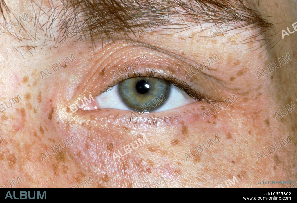 Editorial use only . Kayser-Fleischer rings (KF rings) are dark rings that appear to encircle the iris of the eye. They are due to copper deposition in part of the cornea (Descemet's membrane) as a result of particular liver diseases.