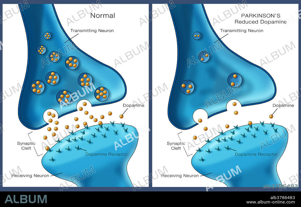 Labelled illustration showing low levels of the neurotransmitter dopamine in a neuron affected by Parkinson's disease (right) and normal levels on the left.