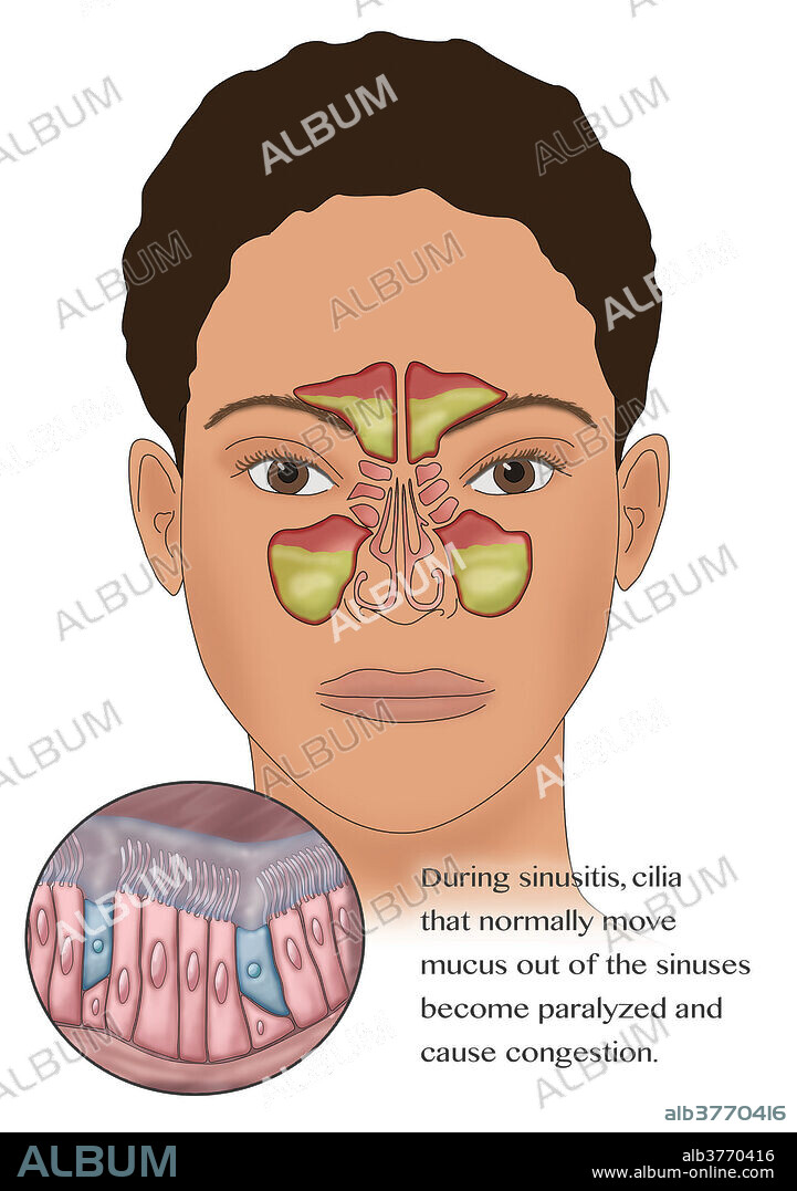 Sinusitis, illustration. Sinusitis, also known as a sinus infection or rhinosinusitis, is inflammation of the sinuses resulting in symptoms. Common signs and symptoms include thick nasal mucus, a plugged nose, and pain in the face. Other signs and symptoms may include fever, headaches, poor sense of smell, sore throat, and cough. The cough is often worse at night. Serious complications are rare. It is defined as acute rhinosinusitis (ARS) if it lasts less than 4 weeks, and as chronic rhinosinusitis (CRS) if it lasts for more than 12 weeks.