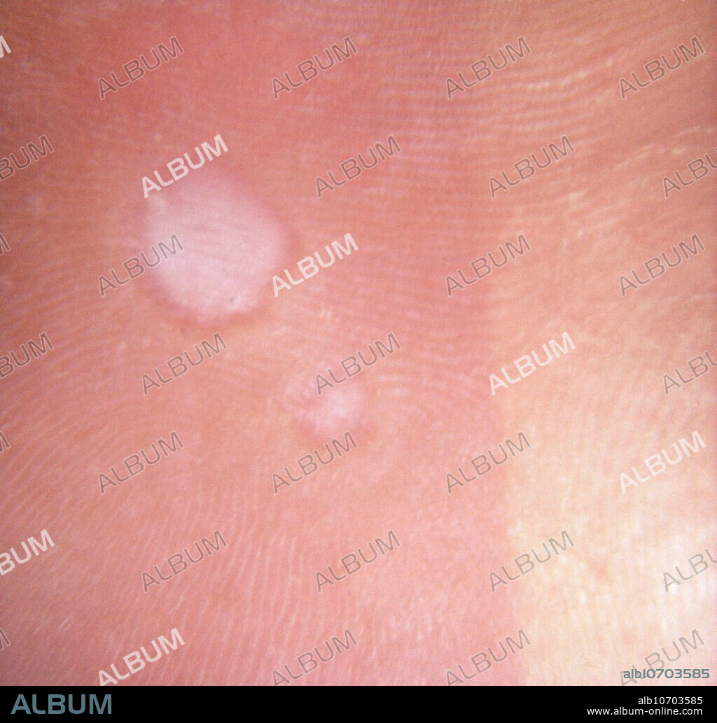Close up of pitted keratolysis, a non-contagious bacterial skin infection often caused by hot, humid weather, excessive sweating, and restrictive footwear.