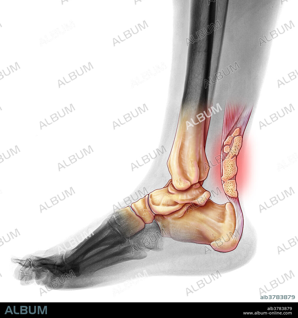 Illustration of achilles tendinitis in an x-ray of the foot. The image shows the calcification of the achilles tendon due to achilles tendinitis. Achilles tendinitis, the inflammation of the achilles tendon, can be caused by overstretching, traumatic injury and obesity. If the inflammation is not treated and the tendon rested and allowed to heal, calcification may result (as in this case). Calcification may require surgical treatment, although if the tendinitis is diagnosed early it can be treated by using ultrasound.