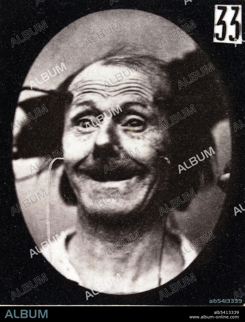 The facial expression of surprise on the human face being induced by electrical currents. Guillaume-Benjamin-Amand Duchenne de Boulogne (September 17, 1806 - September 15, 1875) was a French neurologist who advanced the science of electrophysiology. Influenced by the beliefs of physiognomy, Duchenne wanted to determine how the muscles in the human face produce facial expressions which he believed to be directly linked to the soul of man. He triggered muscular contractions with electrical probes, recording the resulting distorted and often grotesque expressions with the recently invented camera. He published his findings in 1862, together with extraordinary photographs of the induced expressions, in the book The Mechanism of Human Physiognomy (Mecanisme de la physionomie Humaine). The work was an important resource used by Charles Darwin for his own study on the genetics of behavior, but in recent years it has been reclaimed as an important landmark in the history of the photographic arts.