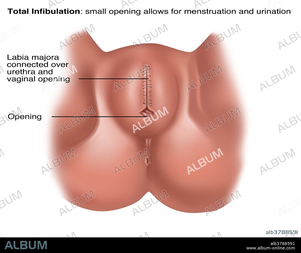 infibulation 