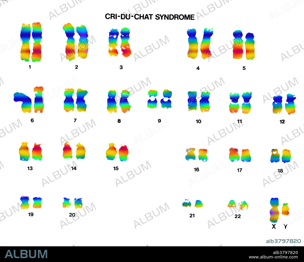 Colour enhanced micrograph of a karyotype of a patient with cri du chat syndrome (also known as Cat cry syndrome). Cri du chat syndrome is a group on syndromes including mental retardation, high-pitched cry sounds (like a cat), microcephaly, low birth weight, hypertelorism, a small jaw, low-set ears, partial webbing of fingers or toes, skin tags in front of the ear, slow development of motor skills, and a simian crease in the palm of the hand. The syndrome is caused by missing information on chromosome 5.