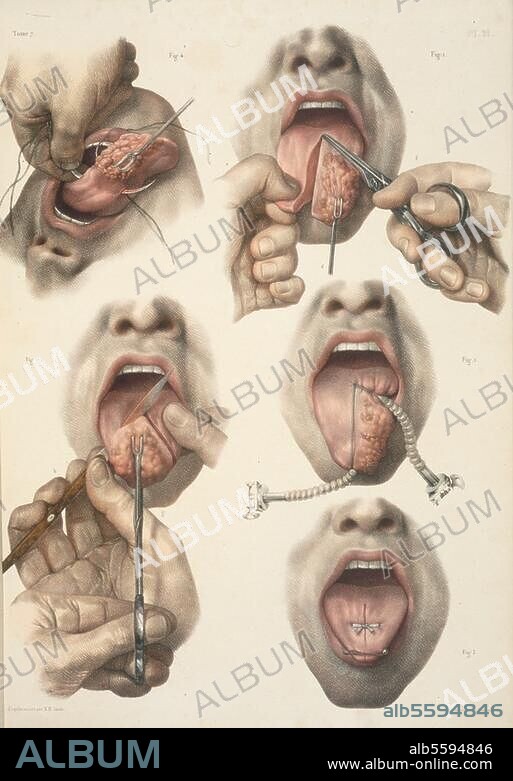 Medicine / Tongue Cancer - Carcinoma Linguae. "Cancer de la langue". (Operation of tongue cancer). Col. lithograph after drawing by Nicolas Henri Jacob (1782-1871). From: M.J. Bourgery, Traité complet de l'anatomie de l'homme, 1831-54, vol. 7, pl. 21. Private Collection.