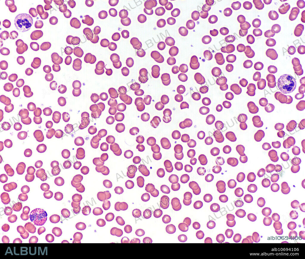 Low magnification photomicrograph of blood cells in a smear. The majority of the cells are red blood cells. The donut shape of many of the cells is a reflection of their bi-concave shape. Three white cells are seen in this portion of the smear. Each of these cells is a granulocyte, namely two neutrophils and one eosinophil. Wrights stain. x700.