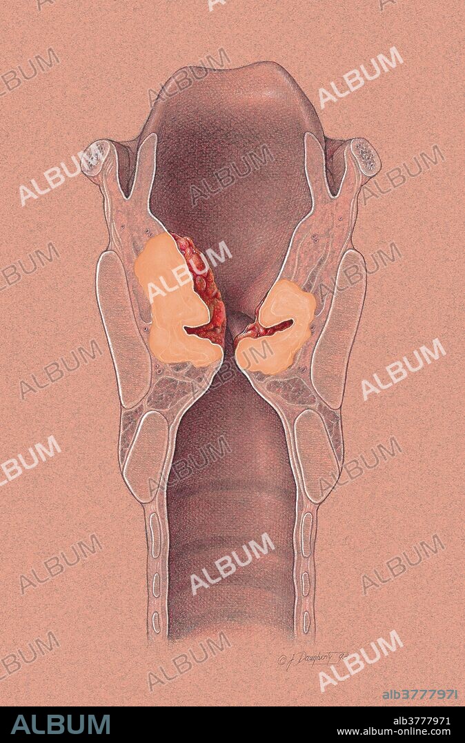 Illustration of stage IV laryngeal carcinoma in both the glotic and supraglottic regions of the larynx. Like all cancers, laryngeal cancer is the result of uncontrolled division by the body's cells. As these cells divide and accumulate, a mass develops. The larynx is positioned in the anterior neck and plays a critical role in normal breathing, swallowing, and speaking. Damage to the larynx or its tissues can result in interference with any or all of these functions. Treatment for this cancer usually involves radiation therapy, surgery, or a combination of the two.