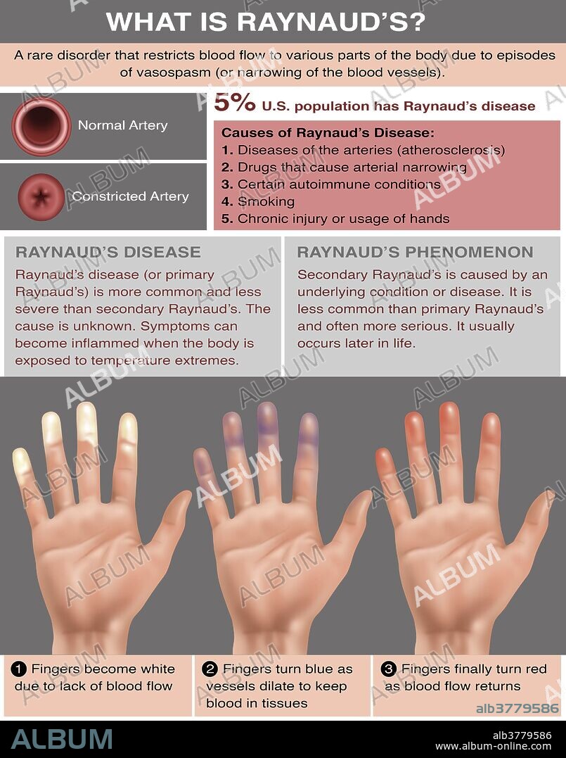 Raynaud's Disease Information Pamphlet