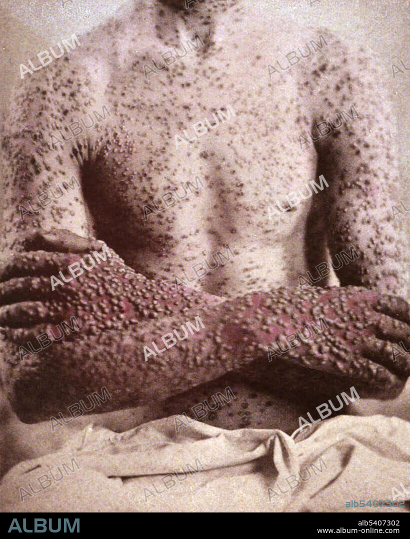 Smallpox, Variola Virus, 1886