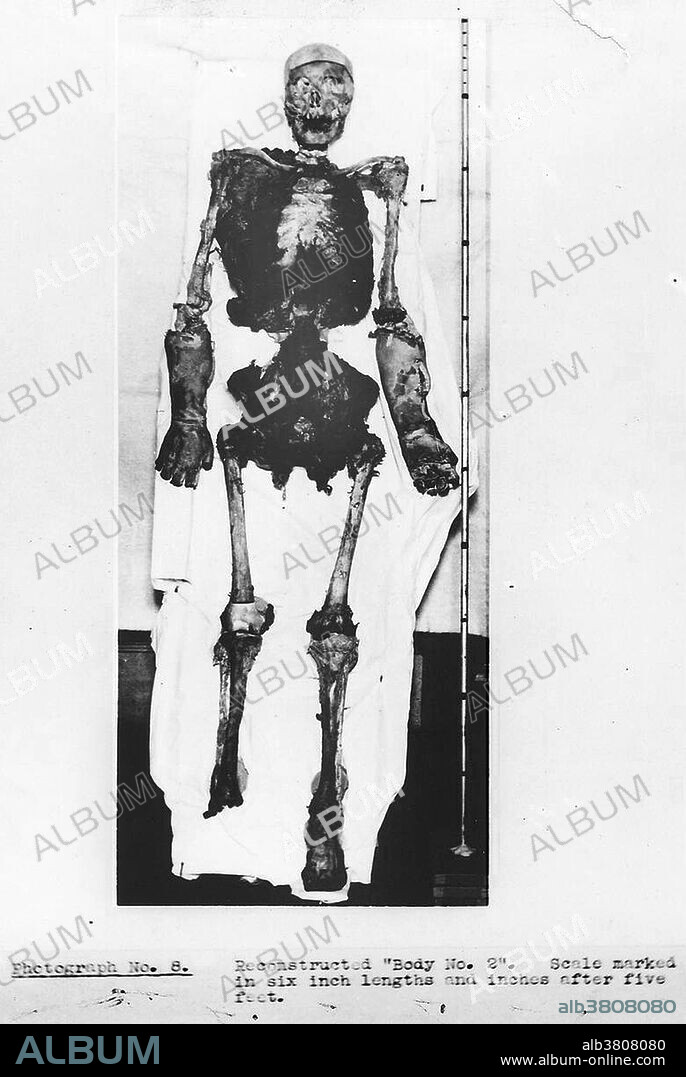 Isabella Ruxton reconstructed body no. 2, 1935. Because the body parts of the two victims were jumbled and had to be reassembled, newspapers called the case the "Jigsaw Murders." Buck Ruxton (1899-1936) was a Parsi doctor and murderer who strangled his wife Isabella. In order to prevent their housemaid, Mary Jane Rogerson, from discovering his crime before he could dispose of the body, he suffocated her too. Ruxton then proceeded to dismember and mutilate both bodies to hide their identities. The case is remembered now for the innovative forensic techniques employed in solving it. The bodies were identified using the fledgeling techniques of fingerprint identification, forensic anthropology to superimpose a photograph over the X-ray of a victim's skull and forensic entomology to identify the age of maggots and thus the approximate date of death. This was one of the first cases where such forensic evidence was successfully used to convict a criminal in the United Kingdom.