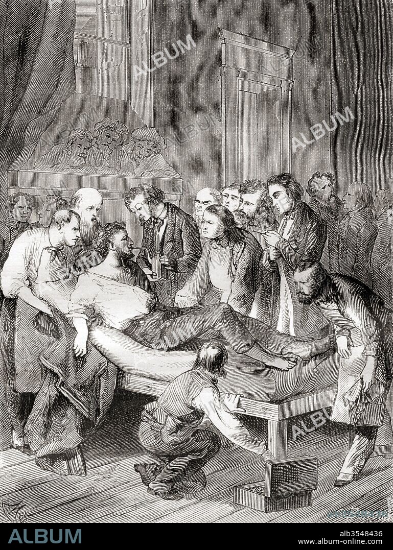 The first public demonstration of the use of inhaled ether as a surgical anaesthetic in 1846 by an American dentist, William Thomas Green Morton (1819 – 1868). From Les Merveilles de la Science, published c.1870.
