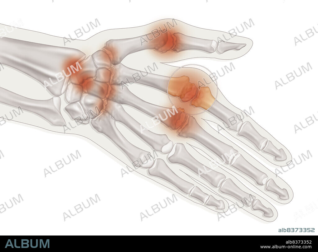 Illustration of a hand suffering from rheumatoid arthritis, with a deterioration of the surface of the bone and cartilage, thickening of the synovial membrane, effusion of synovial fluid and swelling.