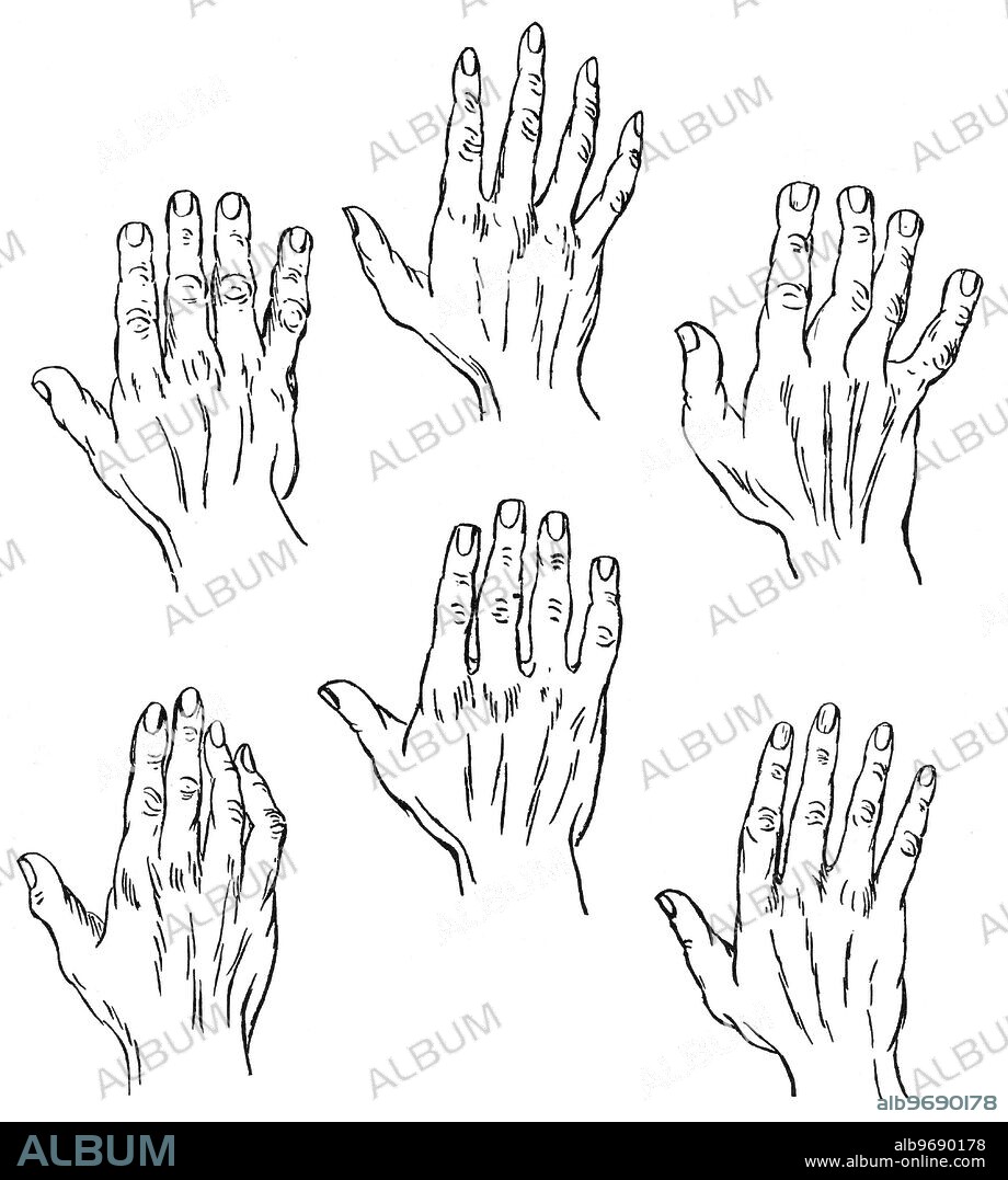 PALMISTRY - CHIROGNOMY. The study of the form of the hand, in its relation to personality, is called Chirognomy, and is an important division of Palmistry. Among the many attempts to classify hand types, is that proposed by the French palmist, Casimir Stanislas D'Arpentigny (born 1798). D'Arpentigny proposed six basic hand types, along with a seventh, which included elements from two or more of these types. The drawings here illustrate (top left); the Elementary, the Psychic, the Spatulate, and (bottom left); the Knotty (or Philosophic), the Square, and the Conic. From D'Arpentigny, La Chirognomie, ou l'art de reconnaître les tendances de l'intelligence d'après les Formes du Main, 1843.